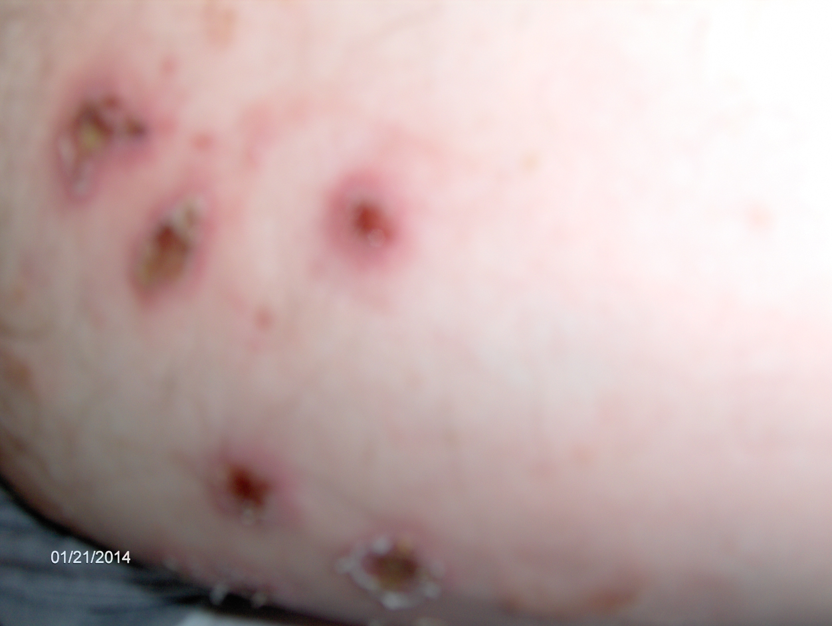 Symptoms of Impetigo - RightDiagnosis.com