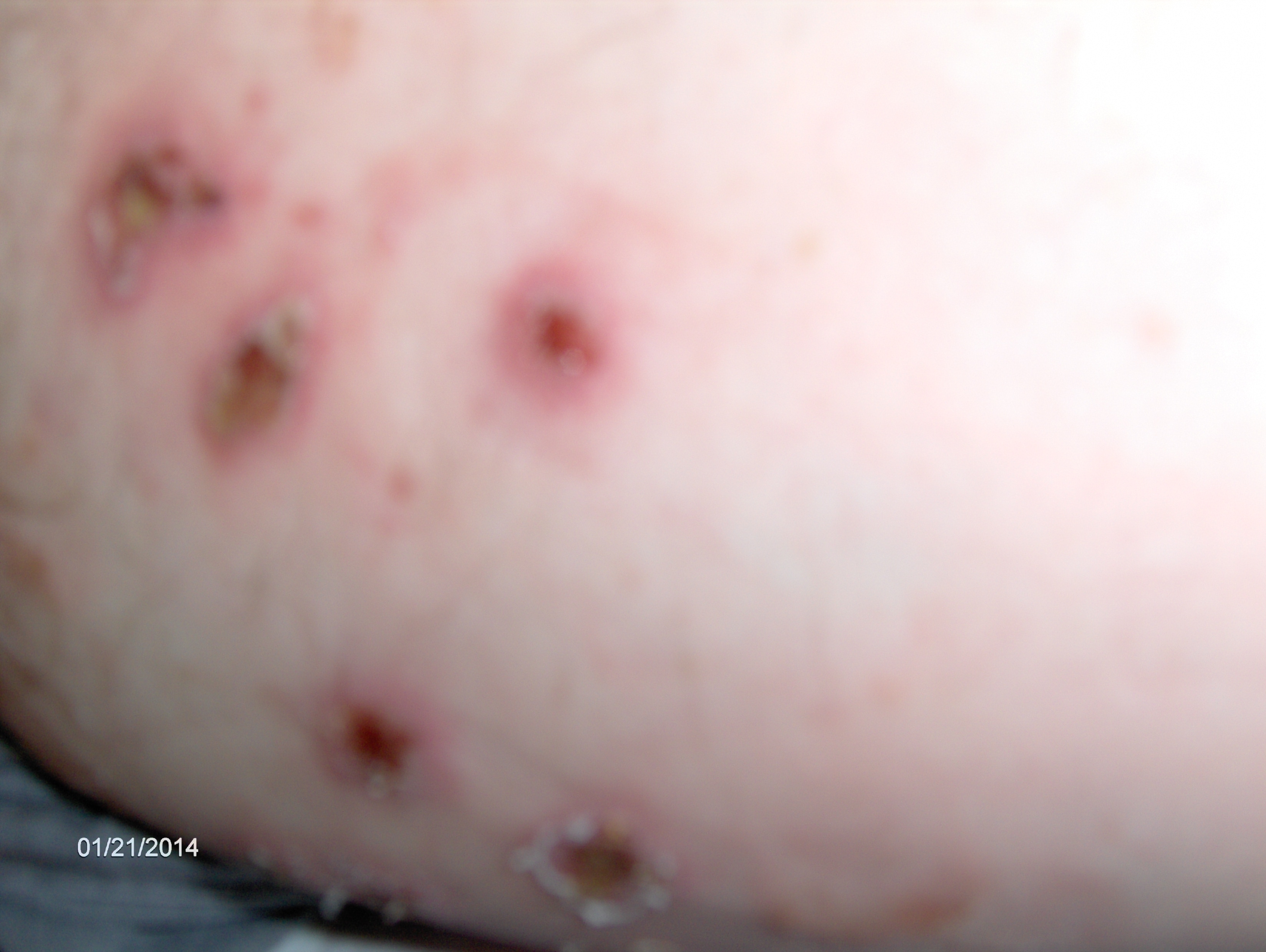 Symptoms of Impetigo - RightDiagnosis.com