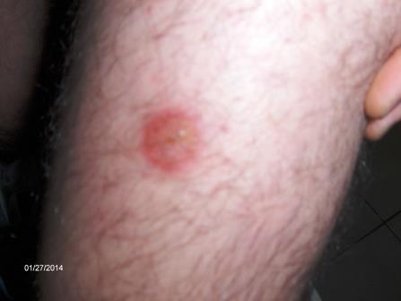 Red Dots on Legs - Pictures, Symptoms, Causes, Treatment